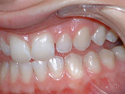 Diastema.jpg